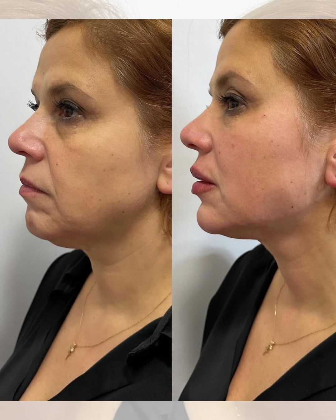 Antes e depois de paciente da Dra. Daniele