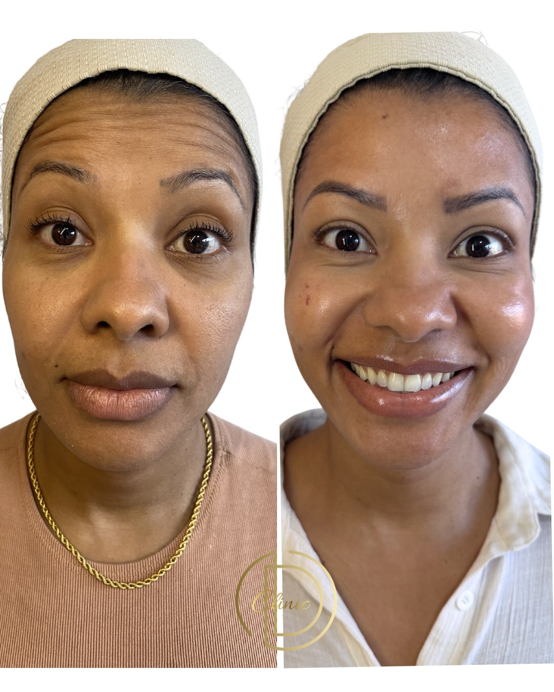 Antes e depois de paciente da Dra. Daniele